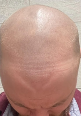 hair transplant photos