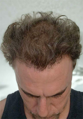 hair transplant before after Photos