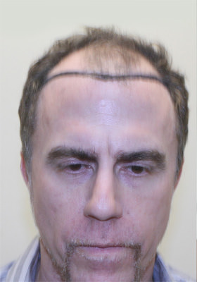 hair transplant before after Photos