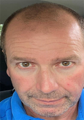 hair transplant photos