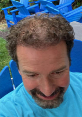 hair transplant photos