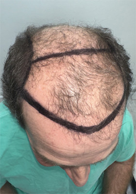 hair transplant before after Photos