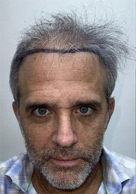 hair transplant photos