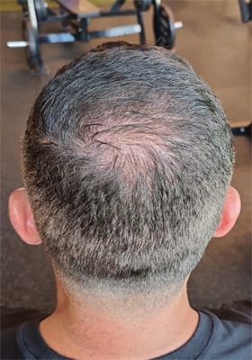 hair transplant photos