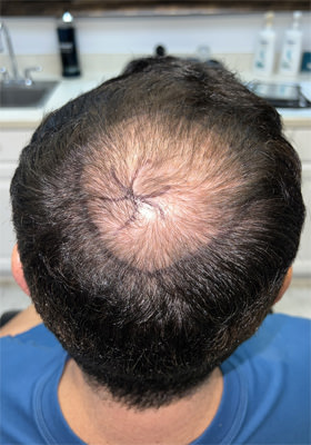 hair transplant photos