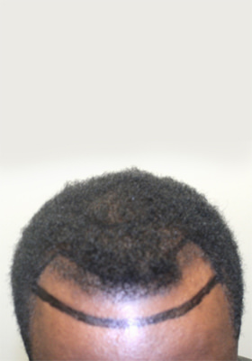 hair transplant before after Photos