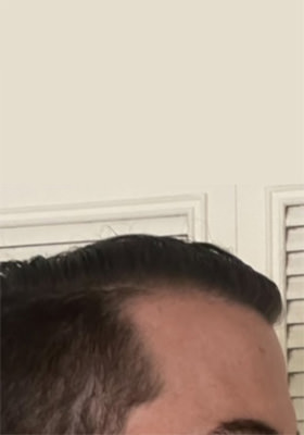 hair transplant before after Photos