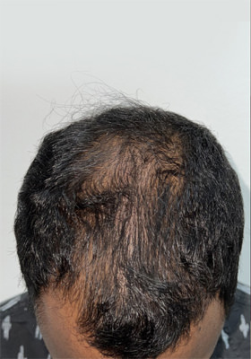 hair transplant before after Photos