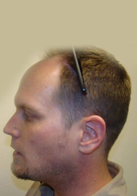 hair transplant photos