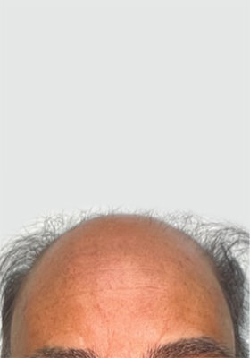 hair transplant photos