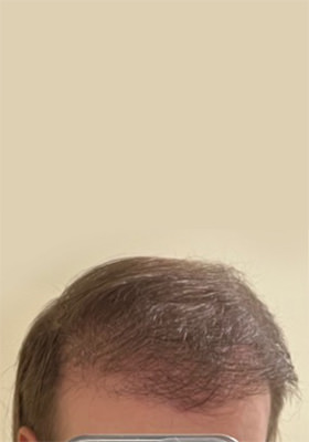 hair transplant before after Photos