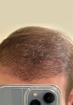 hair transplant before after Photos