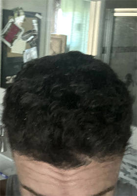 hair transplant photos