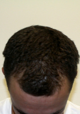 hair transplant photos