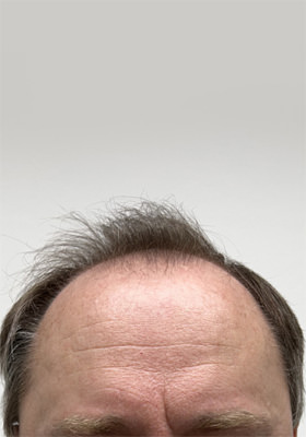 hair transplant photos