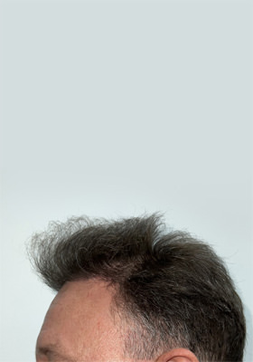 hair transplant photos