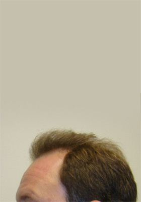 hair transplant photos