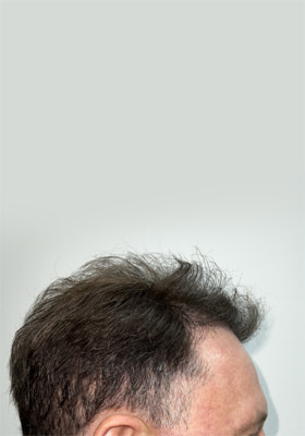 hair transplant photos