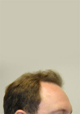 hair transplant photos