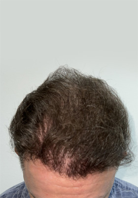 hair transplant photos