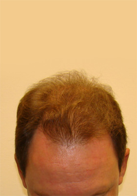 hair transplant photos