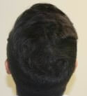 hair transplant photos