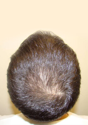 hair transplant before after Photos