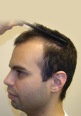 hair transplant photos