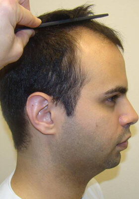 hair transplant photos