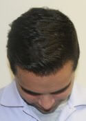 hair transplant photos