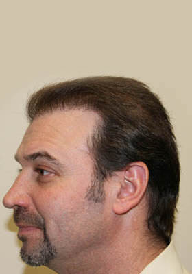 hair transplant before after Photos