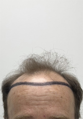 hair transplant before after Photos