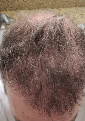 hair transplant before after Photos