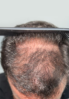 hair transplant before after Photos