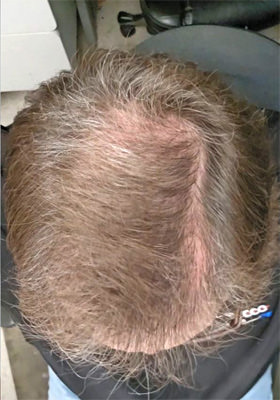 hair transplant photos