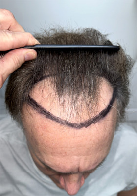 hair transplant before after Photos