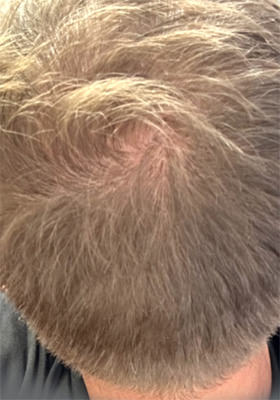 hair transplant photos