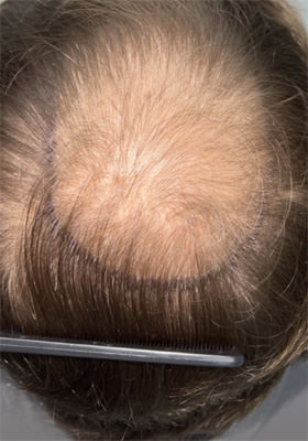 hair transplant photos