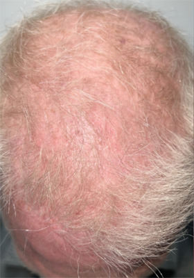 hair transplant before after Photos