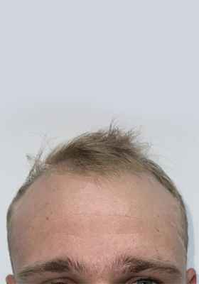 hair transplant before after Photos