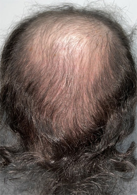 hair transplant before after Photos