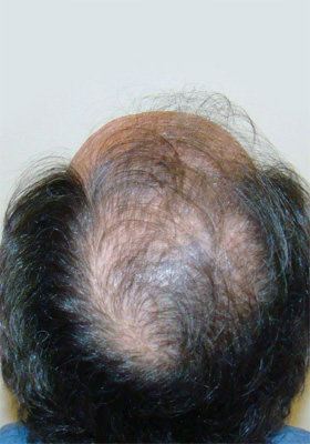 hair transplant before after Photos