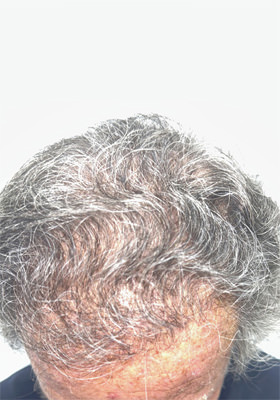 hair transplant before after Photos