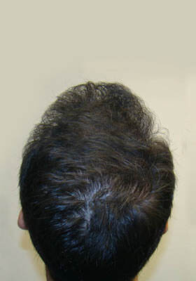 hair transplant photos