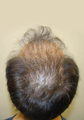 hair transplant photos