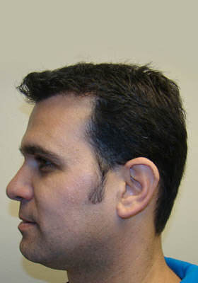 hair transplant photos