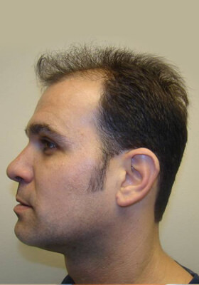 hair transplant before after Photos