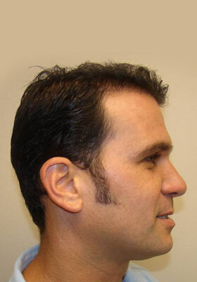 hair transplant before after Photos