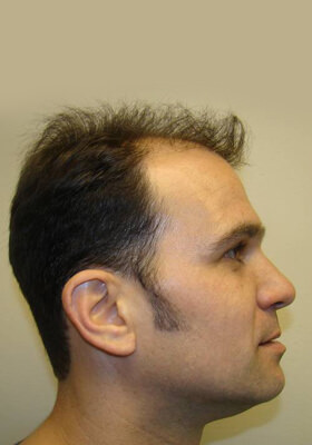 hair transplant before after Photos