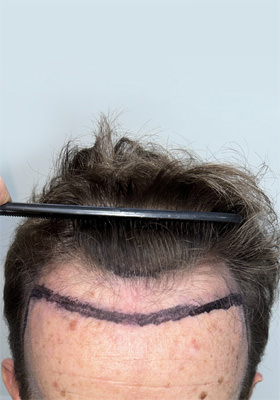 hair transplant before after Photos